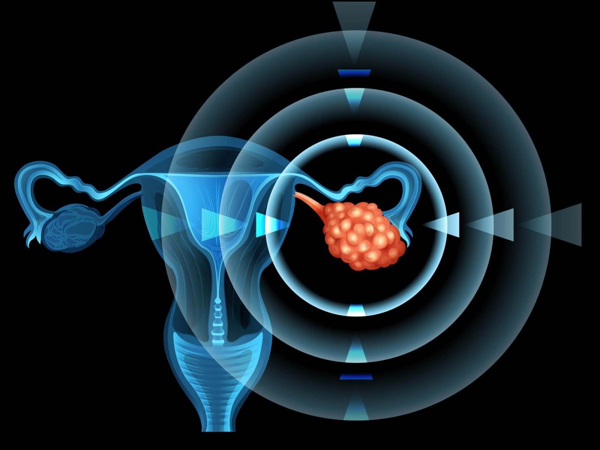 Why Ovarian Cancer is so Hard to Detect | ObGyn Clinic in Singapore | SMG Women's Health