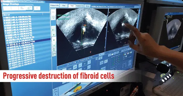 Progressive Destruction of Fibroid Cells